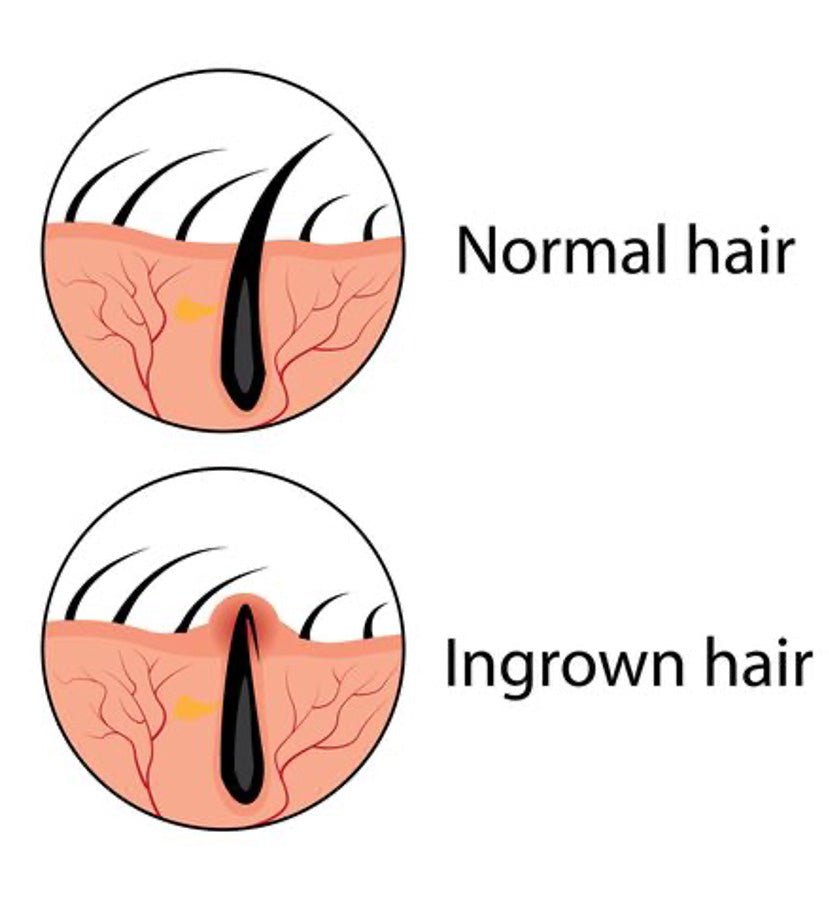 Ingrown Hairs – Everything You Need To Know